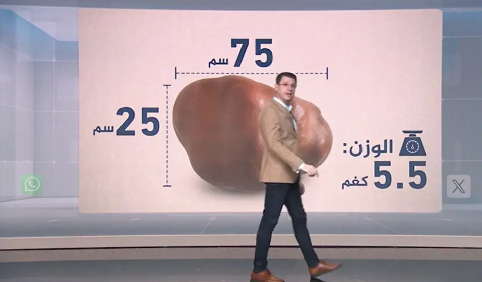 5.5 كيلوغرامات وزن ورم في الرقبة.. عملية استئصال نادرة في السودان تشغل المنصات